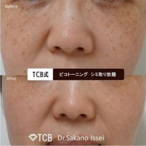 TCBのシミ取り症例写真